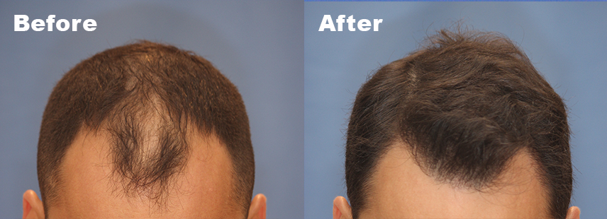 FUE hair transplant Patient 1 before and after results showing improved hairline and density